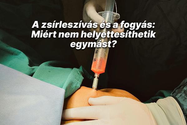 A zsírleszívás és a fogyás: Miért nem helyettesíthetik egymást?