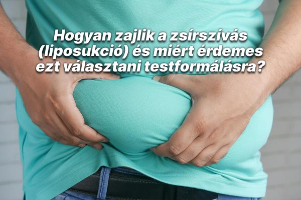 Hogyan zajlik a zsírszívás (liposukció) és miért érdemes ezt választani testformálásra?