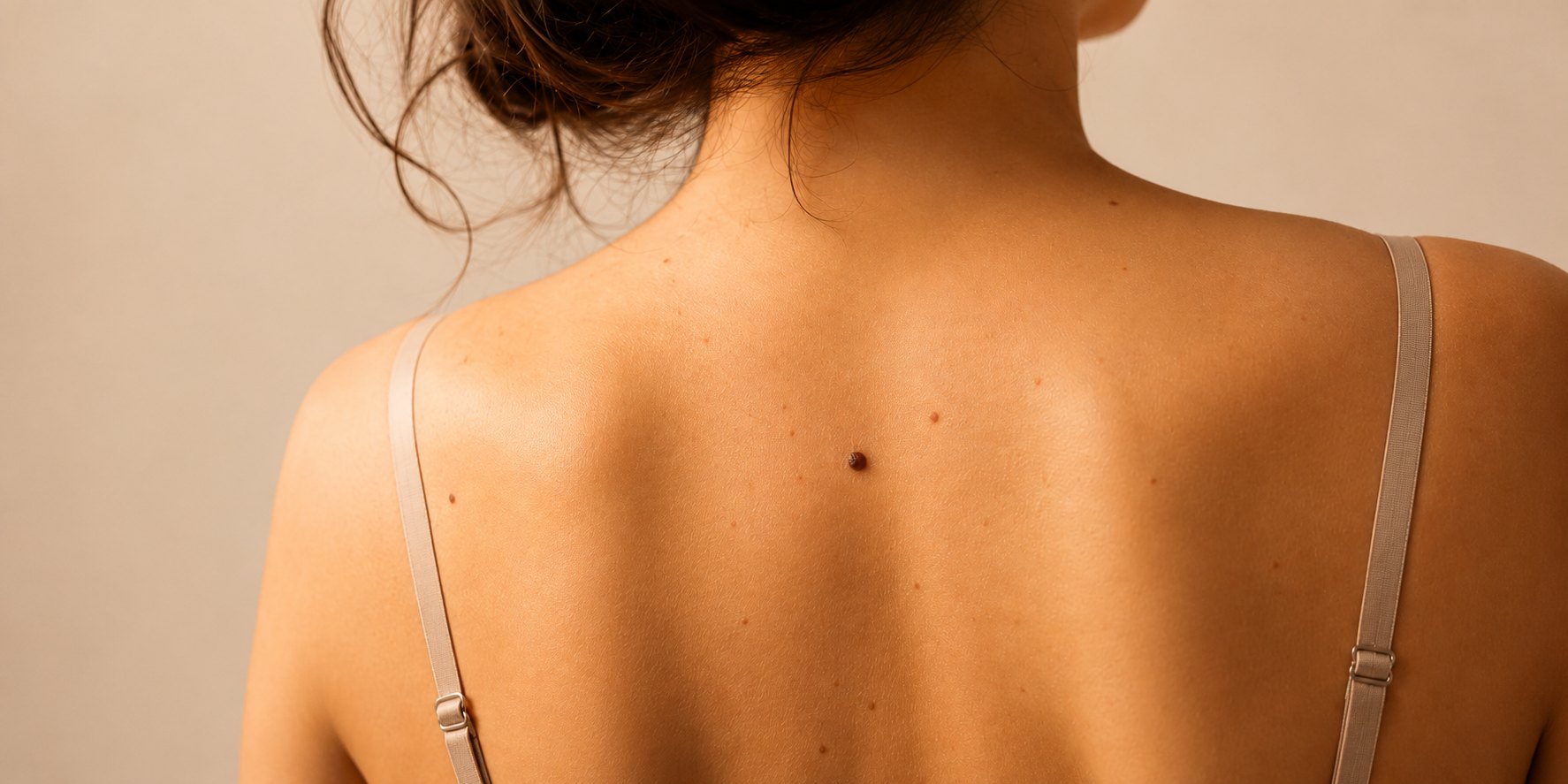 Mole Removal
