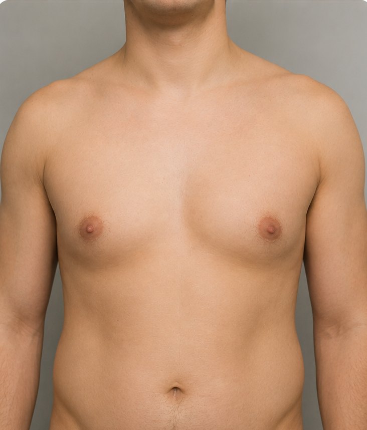 Male Breast Correction – Before