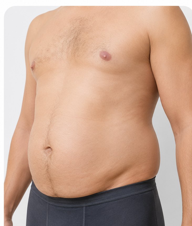 Abdominoplasty – Before